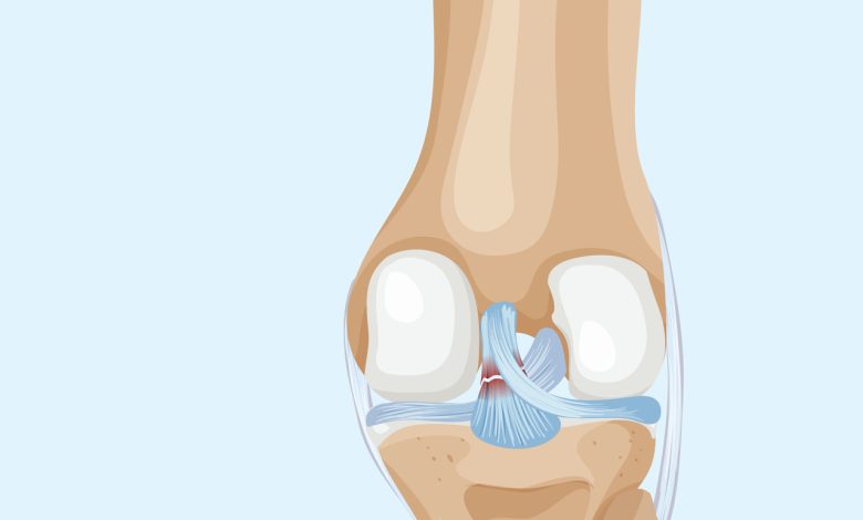 Lesão do LCP a lesão esquecida que pode deixar seu joelho instável