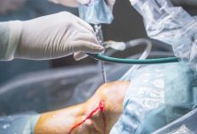 Sutura do menisco quando ela é indicada